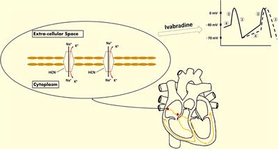 Ivabradine: A Potential Therapeutic for Children With Refractory SVT